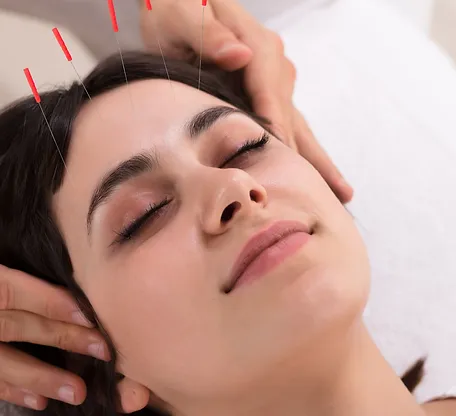 Cosmetic-Acupuncture